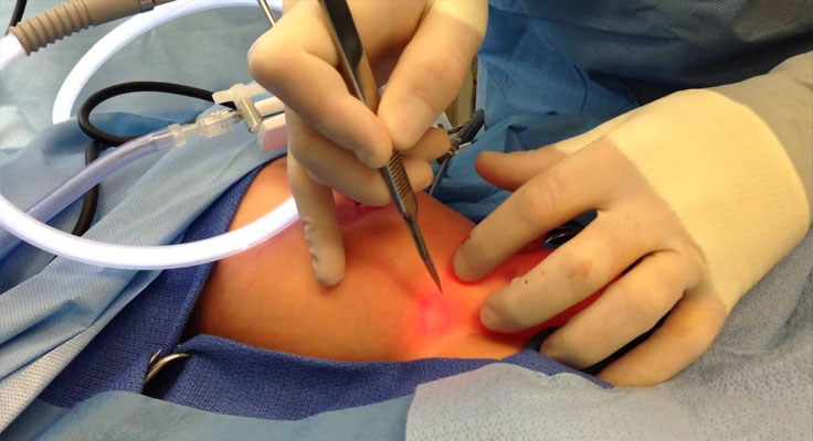 Laparoscopic Inguinal Hernia Repair