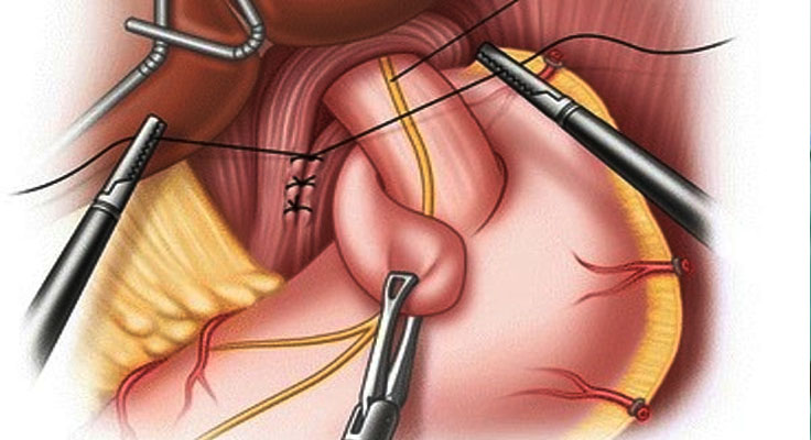 Laparoscopic surgeon in Faridabad