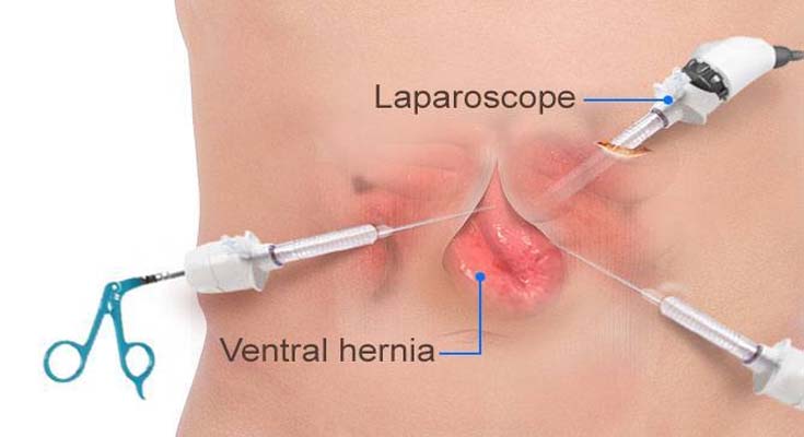 Epigastric Hernia Repair In Faridabad