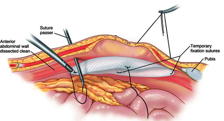 Ventral Hernia Repair Surgeon In Faridabad