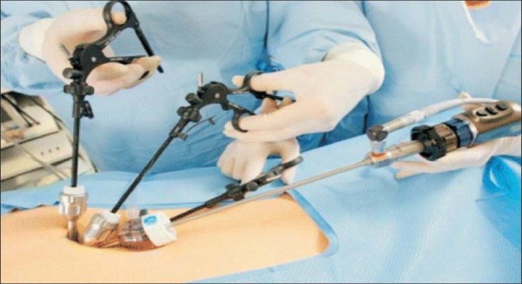Single Incision Laparoscopic Surgeon in Faridabad